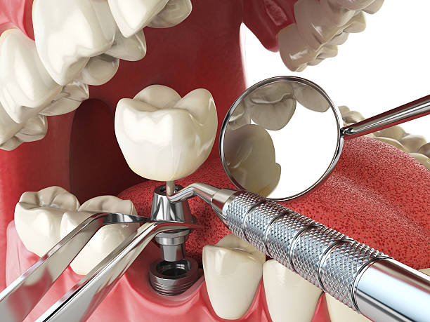 Best Lost Filling or Crown Replacement in Lincoln Beach, OR